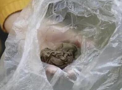  女子术后散发恶臭  罪魁祸首竟然是一团纱布_百