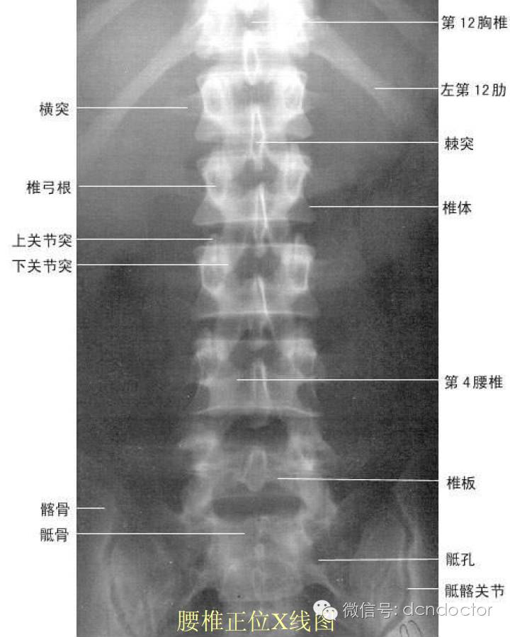 腰椎x光片,就是给腰椎照相.x光片最能反映腰椎的轮廓,形态.