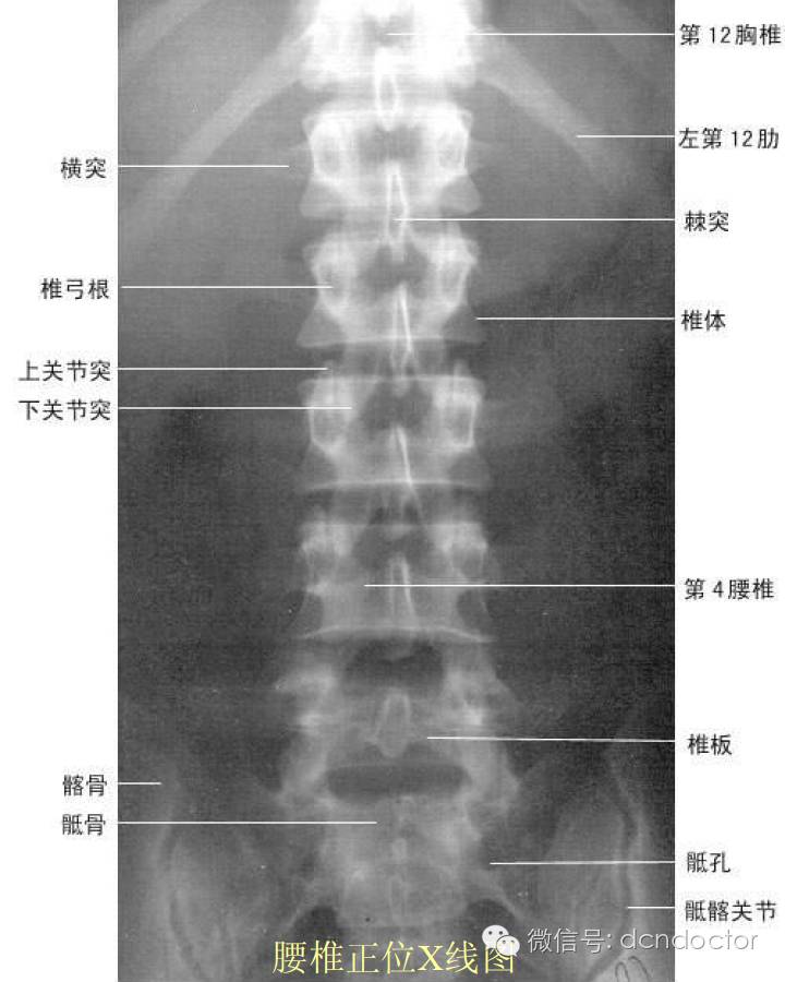 对于腰椎骨折,错位,骨质增生, x光片是最直接的诊断方法.