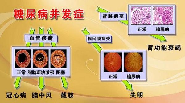 糖尿病人口_图4:全球糖尿病人口-全球糖尿病市场未来发展概况分析(3)