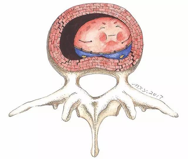 腰间盘突出的真正原因,一位医生把它写成了小