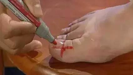 王三喜：体内湿气重？常按这两个穴位，健脾又祛湿