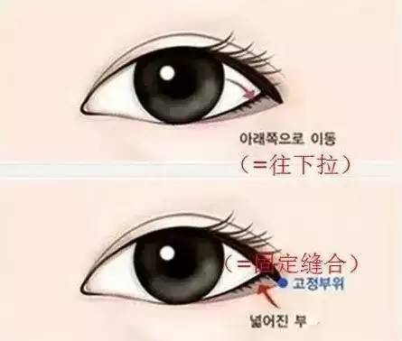 到底有没有必要开外眼角?你适合开外眼角吗?