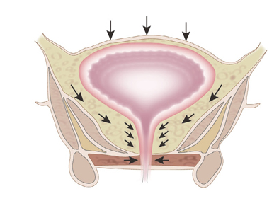 分析如何正确使用女性缩阴用品