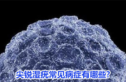 上海明珠医院专家讲解:尖锐湿疣常见病症有哪