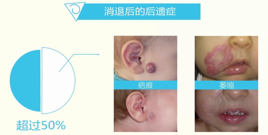 【哈尔滨长峰血管瘤医院】当心!宝宝身上的小