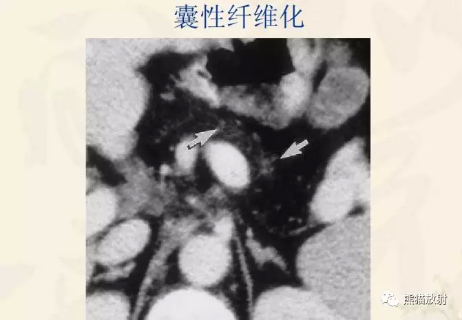 囊性纤维化流行病学:至少85%的囊性纤维化患者临床上有明显的胰腺功能