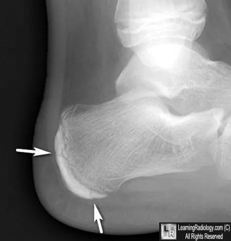 跟骨后缘多个骨化中心骨骺所致图 20 籽骨(sesamoids.