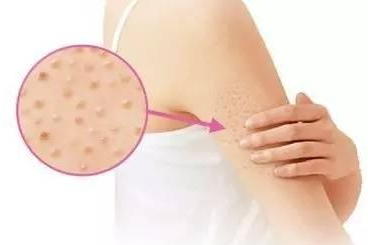 毛周角化症治疗不好吗