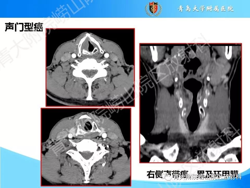 咽喉解剖及常见病变影像诊断