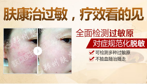 郑州肤康医院收费咋样 郑州哪家医院治疗皮肤