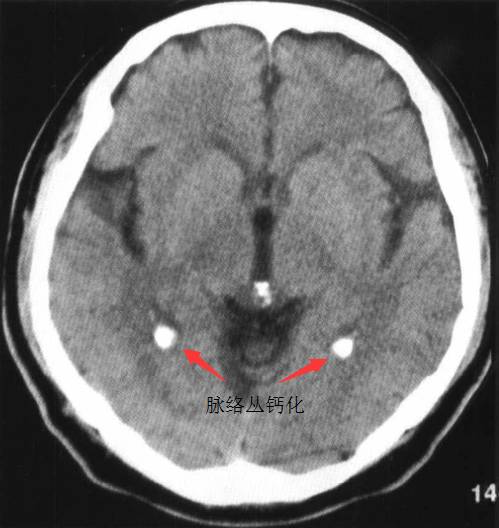 脉络丛的钙化一般没有临床意义,但通过观察侧脑室三角区钙化的脉络丛