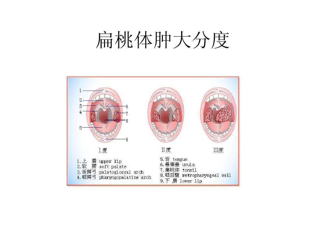 首大李艳华:各种扁桃体腺样体手术优缺点