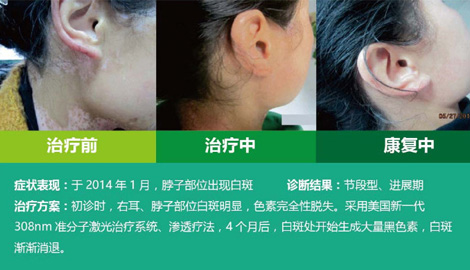 脖子上白斑治疗对比图