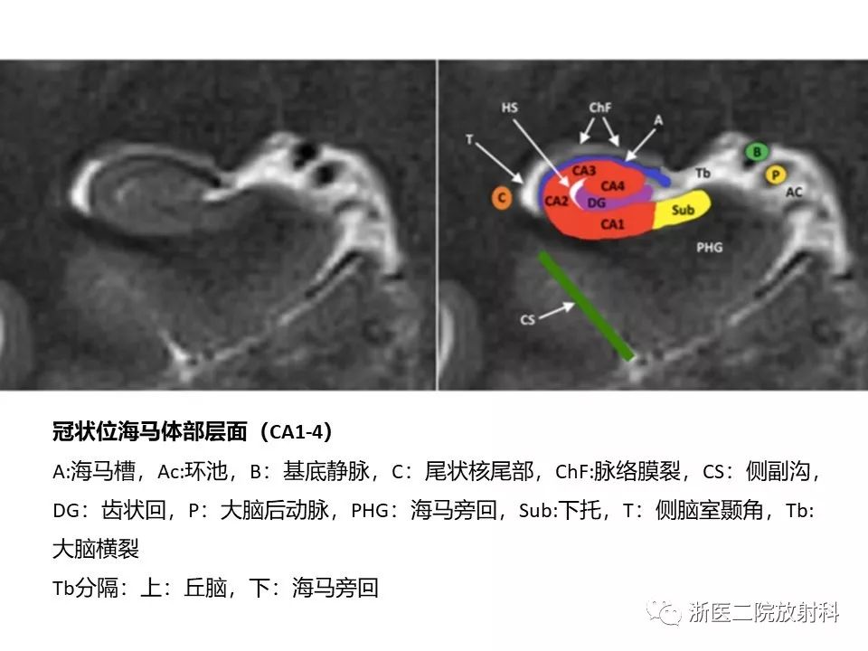 海马正常解剖及病变介绍