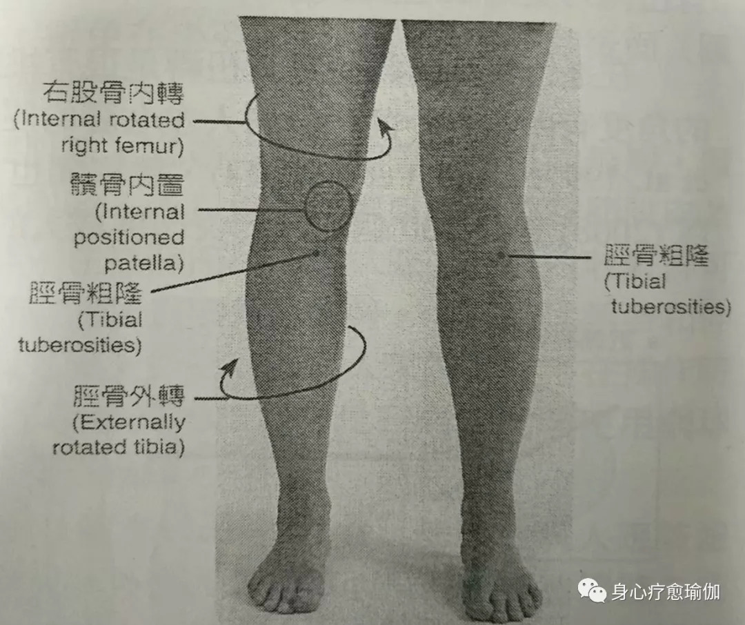 从前方观察胫骨粗隆:它们都对称性地面向前方,或者是一侧朝内(胫骨