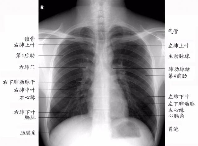 肺野的划分在正位胸片上,肺纹理自肺门向肺野中,外带延伸,且逐级变细