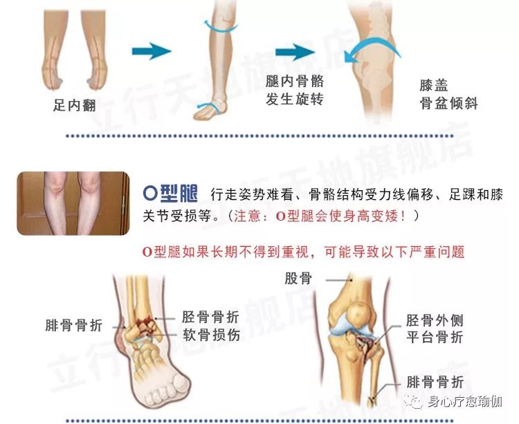 沧州瑜伽理疗:足内翻(高弓足)影响渐进,能纠正但不能急