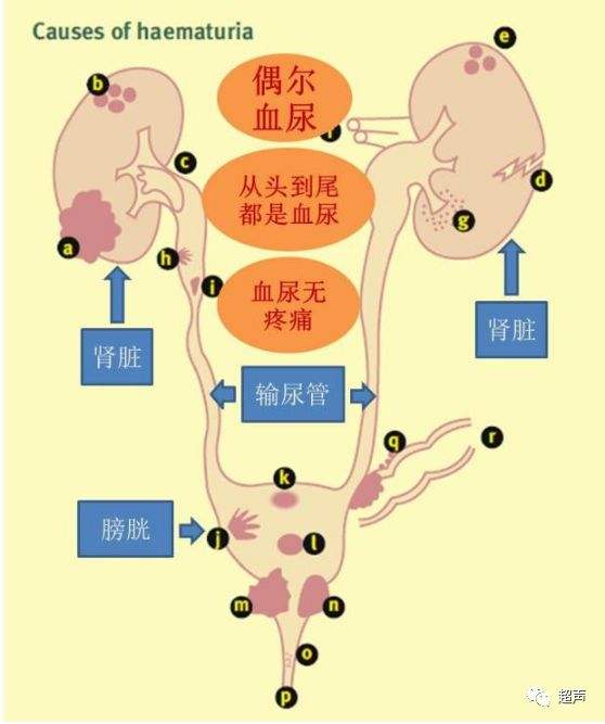 尿路结石尿血了严不严重?听听专家怎么说