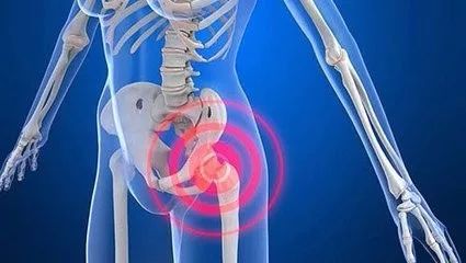 当滑囊发炎时,髋部疼痛将从大腿侧向下扩散,当触及到疼痛区域时,会