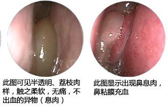 鼻息肉医保能报销吗 鼻息肉手术医保能不能报销