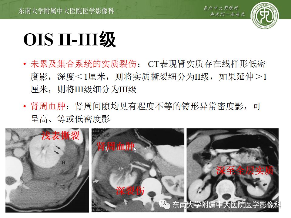 肾损伤的ct分级