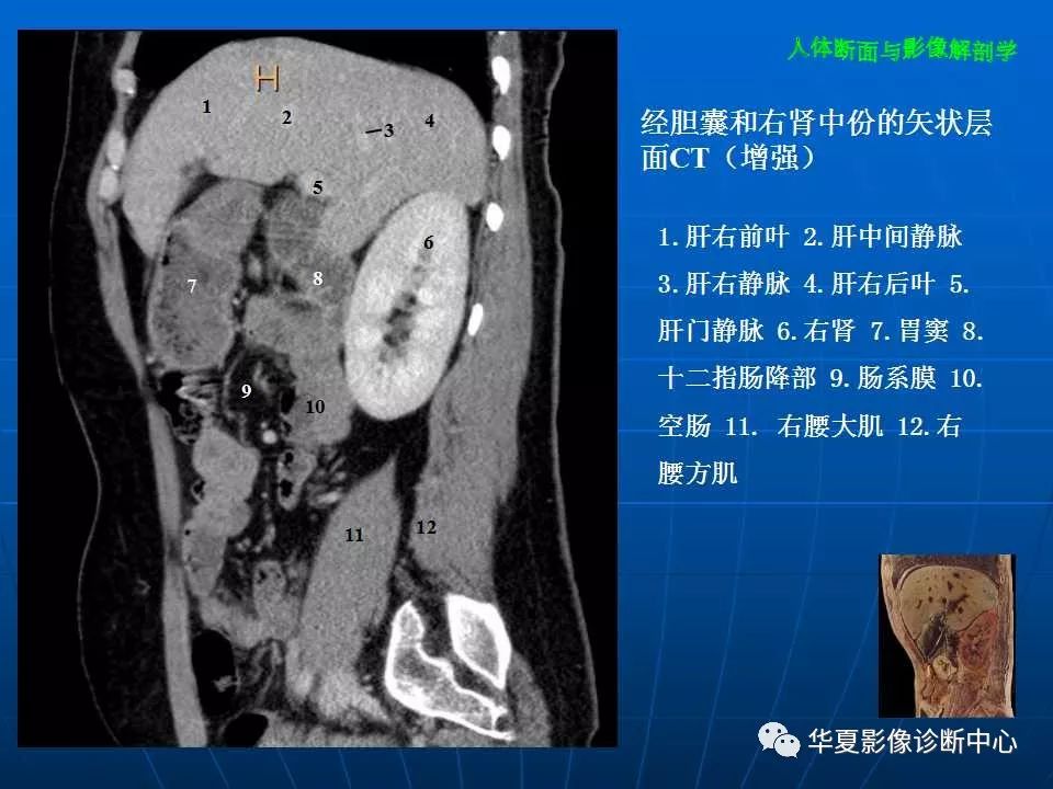 腹部断层影像解剖