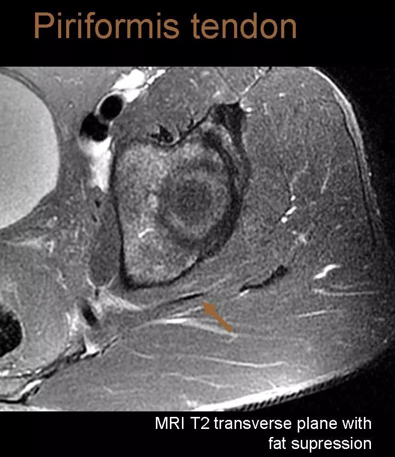 图谱梨状肌综合征相关mri