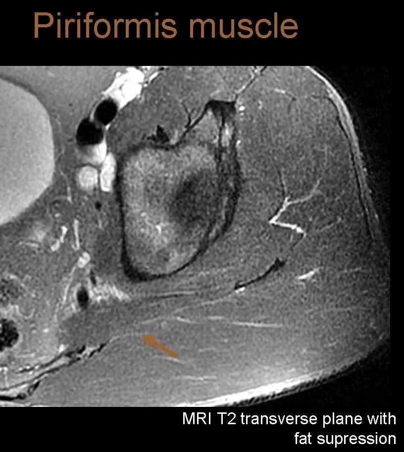 图谱梨状肌综合征相关mri