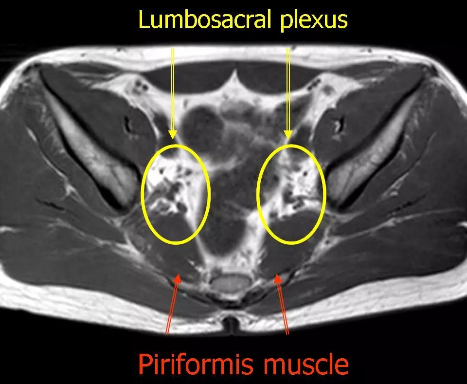 丛图40:mr t1轴位图像:腰骶丛图41:mr t1轴位图像:闭孔肌和坐骨神图42