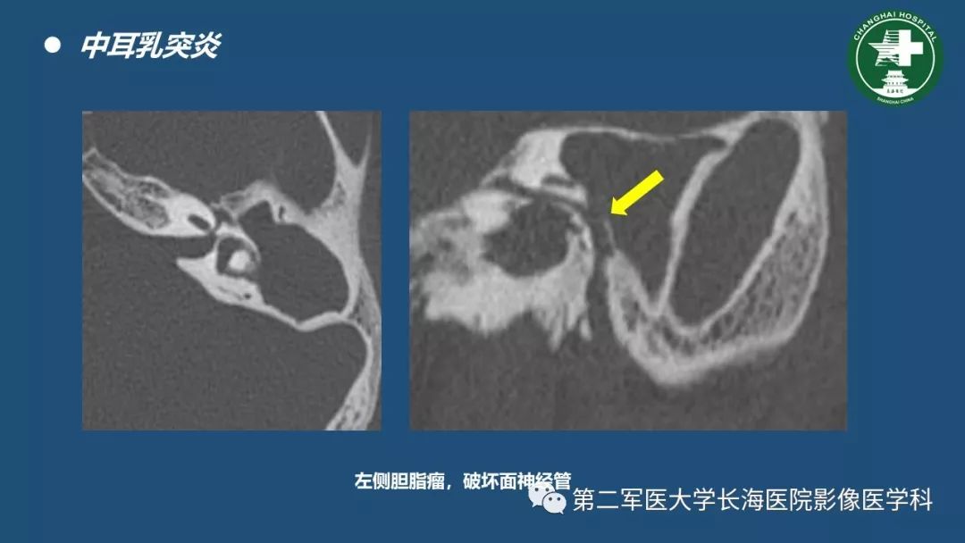 颞骨ct解剖及其常见病变