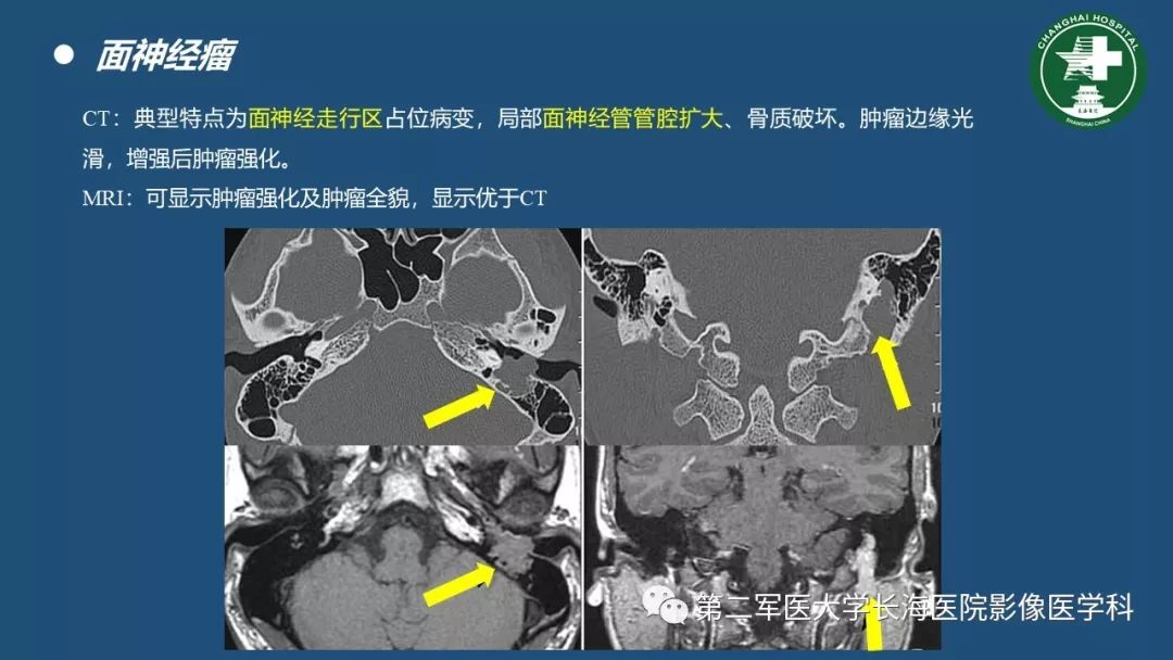 颞骨ct解剖及其常见病变