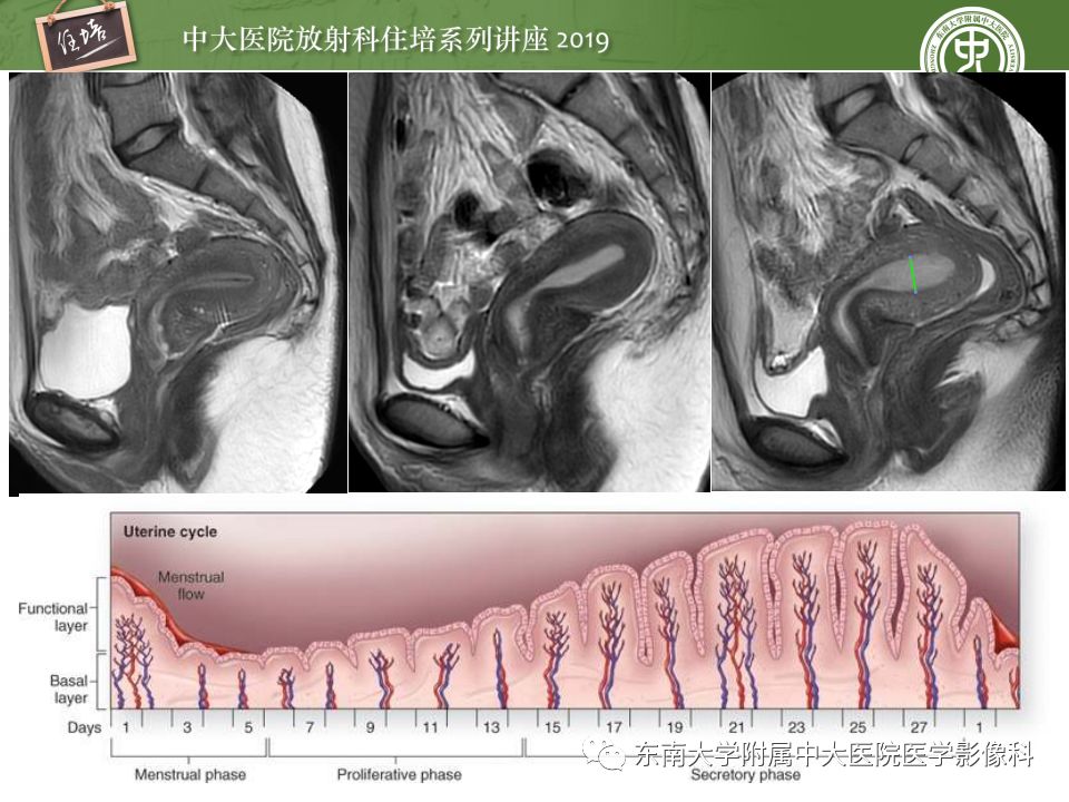 子宫影像解剖及相关mr信号分析