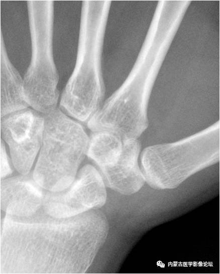 类风湿性关节炎:双手骨质疏松,腕掌关节,桡腕关节及腕骨间关节间隙