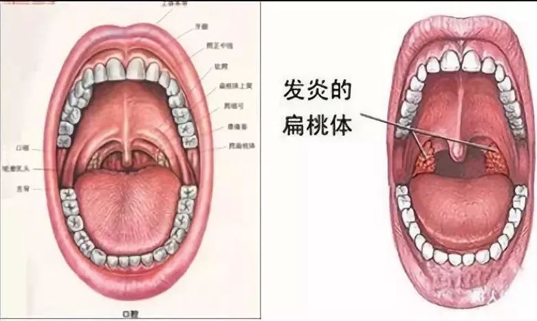 并不是因为扁桃体肥大是什么疑难杂症,不治之症,而是由于扁桃体肿大会