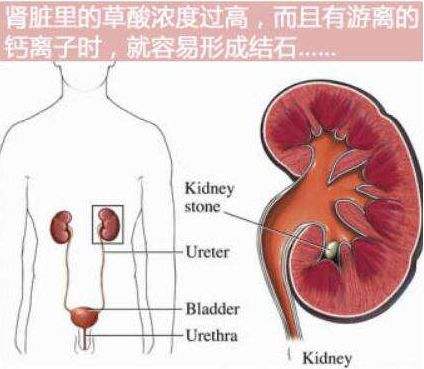 结石的大小并不是决定手术治疗的主要因素,还必须考虑结石的位置