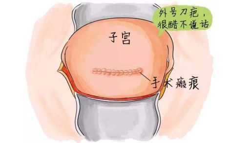 瘢痕子宫如无明显症状不需进行特殊处理,如继续妊娠,需选择妊娠时机