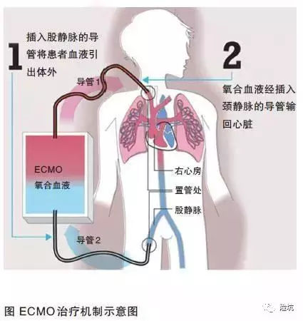 为什么用了ECMO依然救不回你？