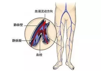 静脉血栓的形成是如何一步步危及人生命的？(图1)