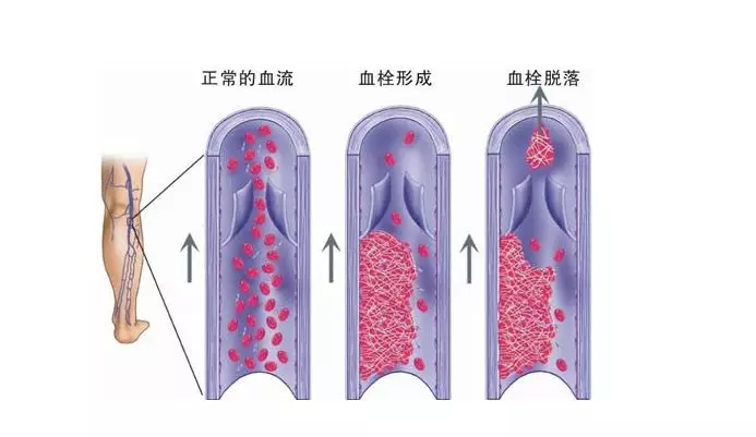 静脉血栓的形成是如何一步步危及人生命的？(图2)