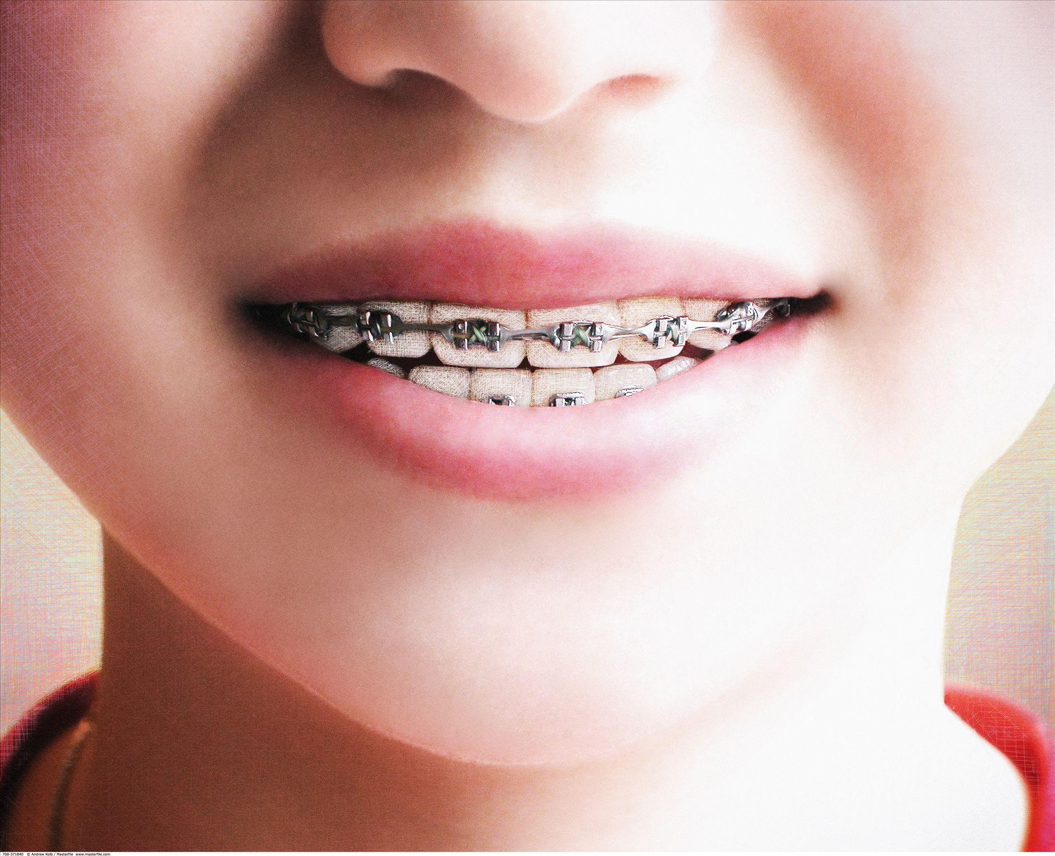 儿童牙齿反颌矫正器图,恒牙,年龄_大山谷图库