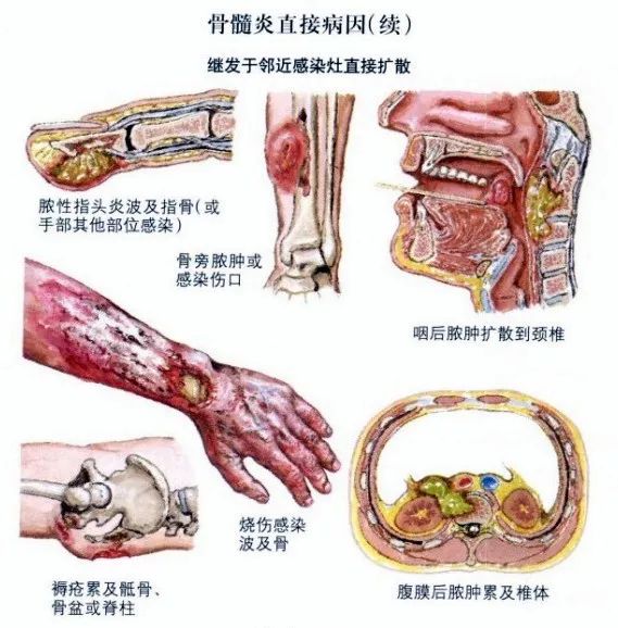 将五阿哥折磨死的附骨疽是一种什么疾病