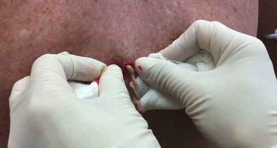 女子挤痘痘导致肺部20个脓肿这是为什么