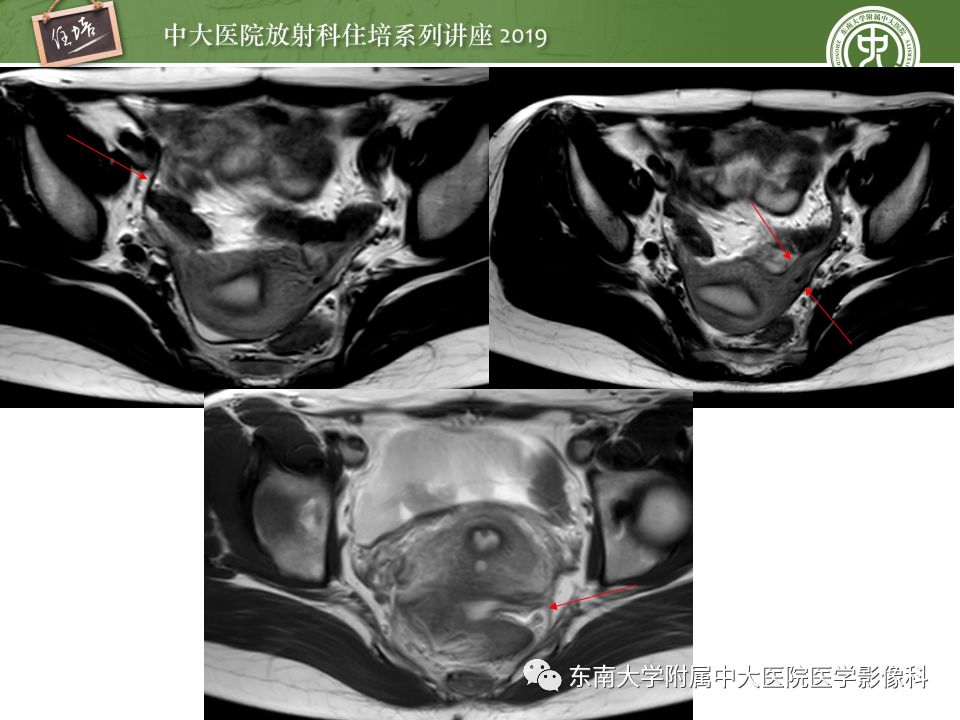 子宫影像解剖及相关mr信号分析