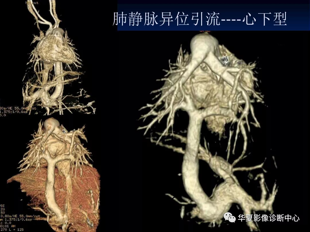 肺静脉畸形引流的影像诊断