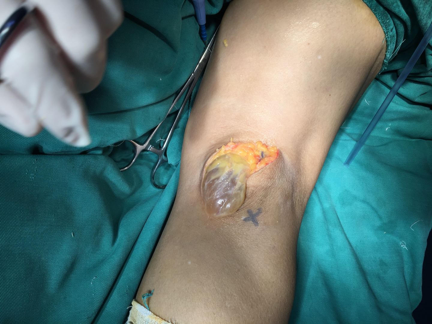 崇州二医院骨三科镜显优势成功开展全关节镜下腘窝囊肿切除术