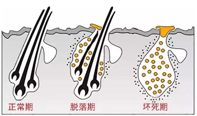 恆美植髮:毛囊壞死的根本原因是什麼?_醫療健康網