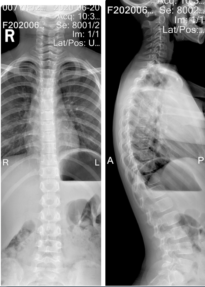 常规dr不能一次性完成全脊柱或全下肢x光影像拍摄,需分别拍摄颈椎