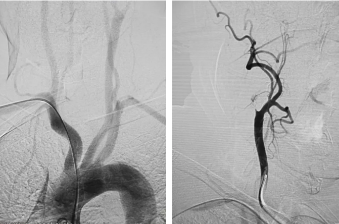 新进展!脑血管造影径路从"股"到"桡"