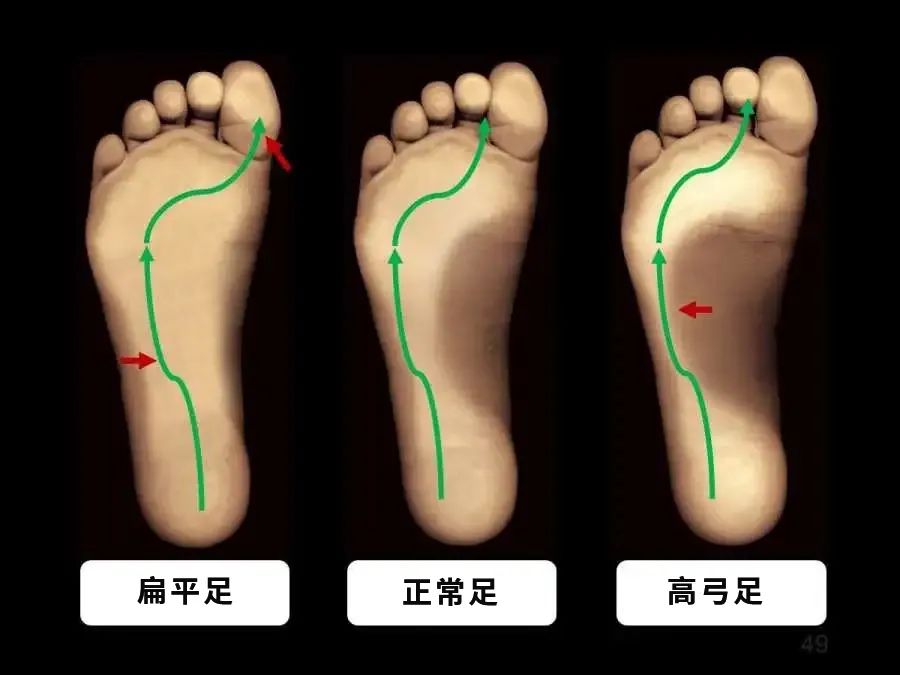 什么是高弓足 高弓足的症状和危害有哪些 北京德尔康尼骨科医院